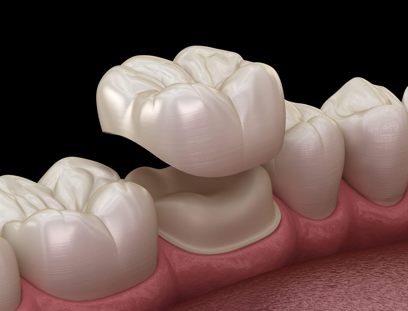 Illustration of a crown being seated on a prepared tooth