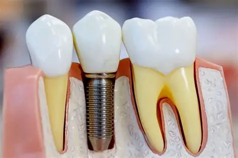 Illustration of a dental implant post placed in the jawbone
