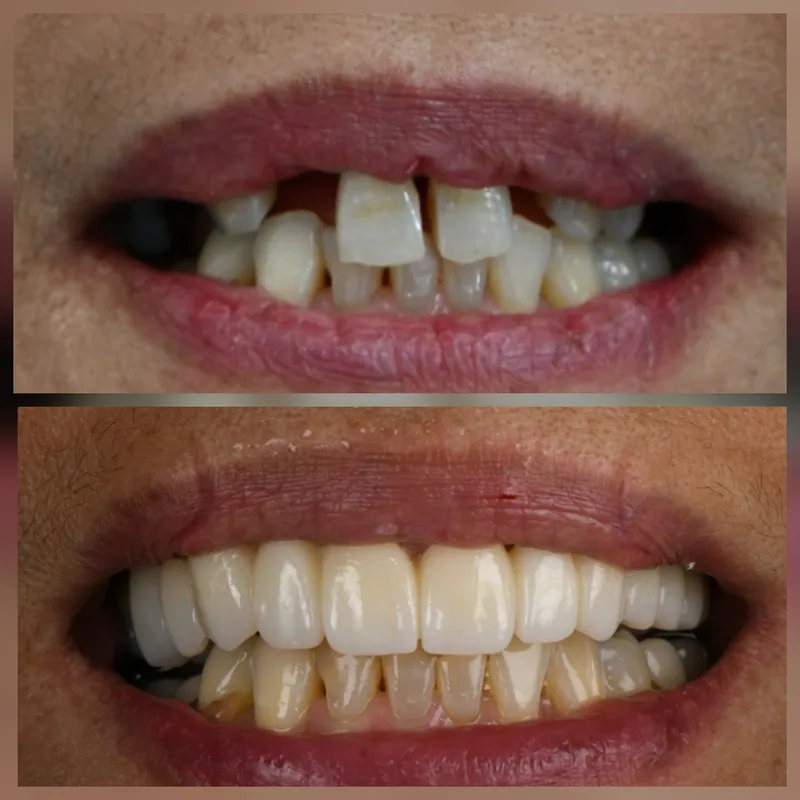 Crown Restoration