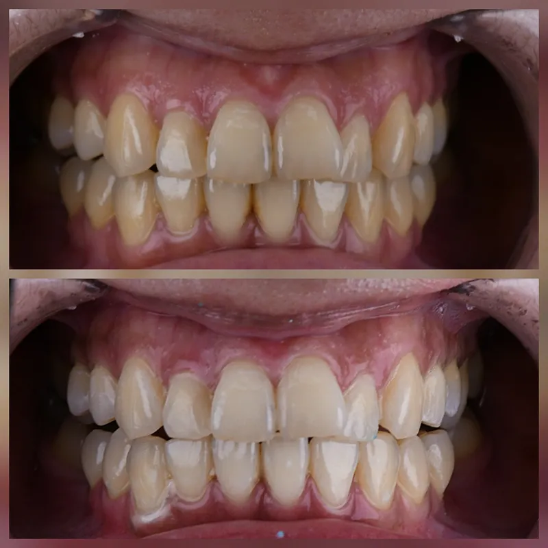 Teeth whitening case, before and after