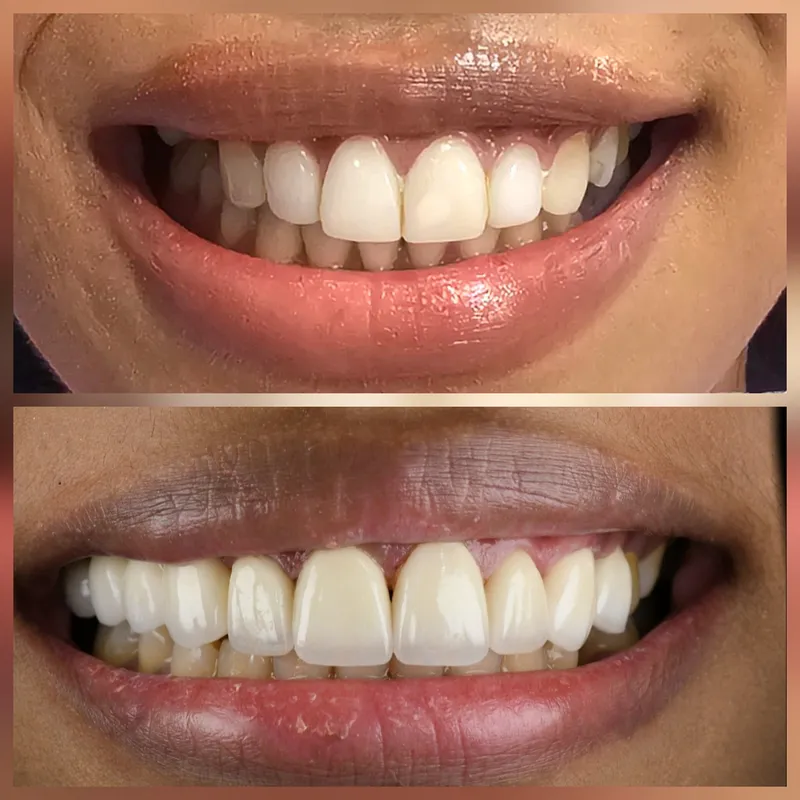 Veneer case, before and after