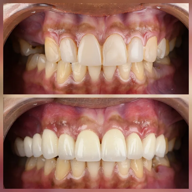 Crown Replacement