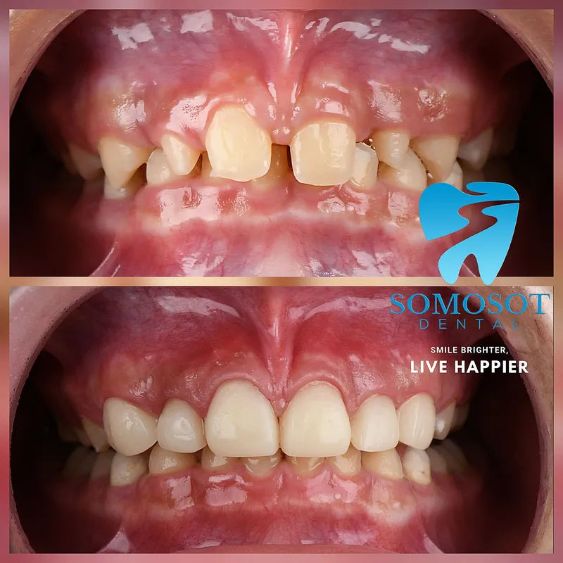 Orthodontic Treatment