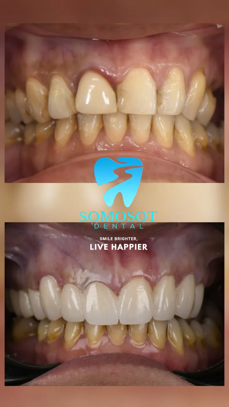 Crown Restoration