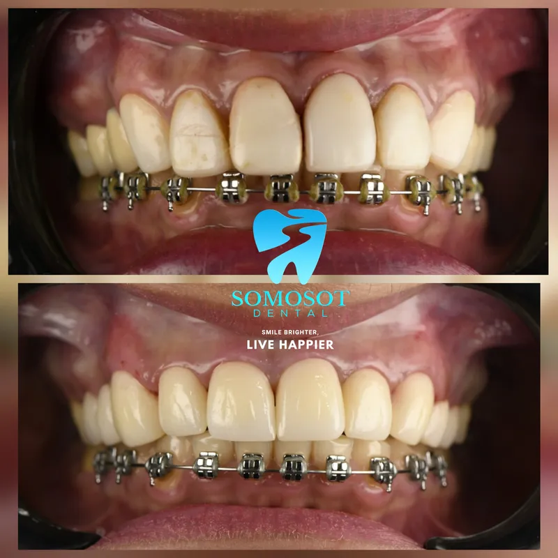 Crown Replacement