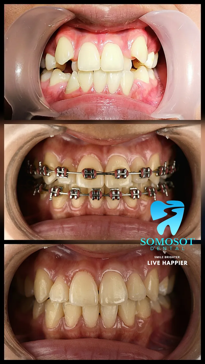 Orthodontic Treatment