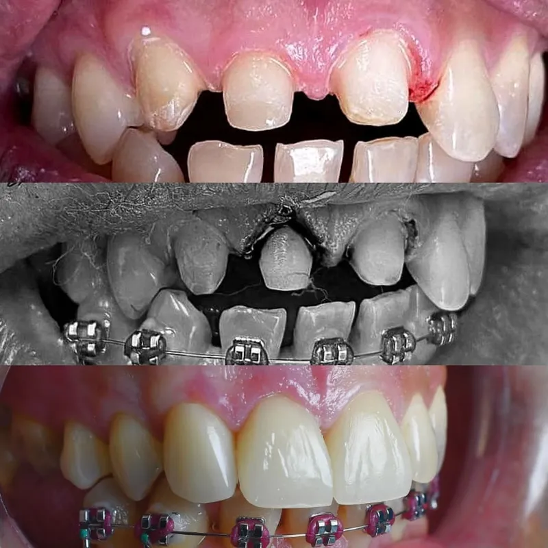 Orthodontic Treatment