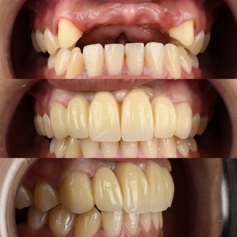 Crown Restoration
