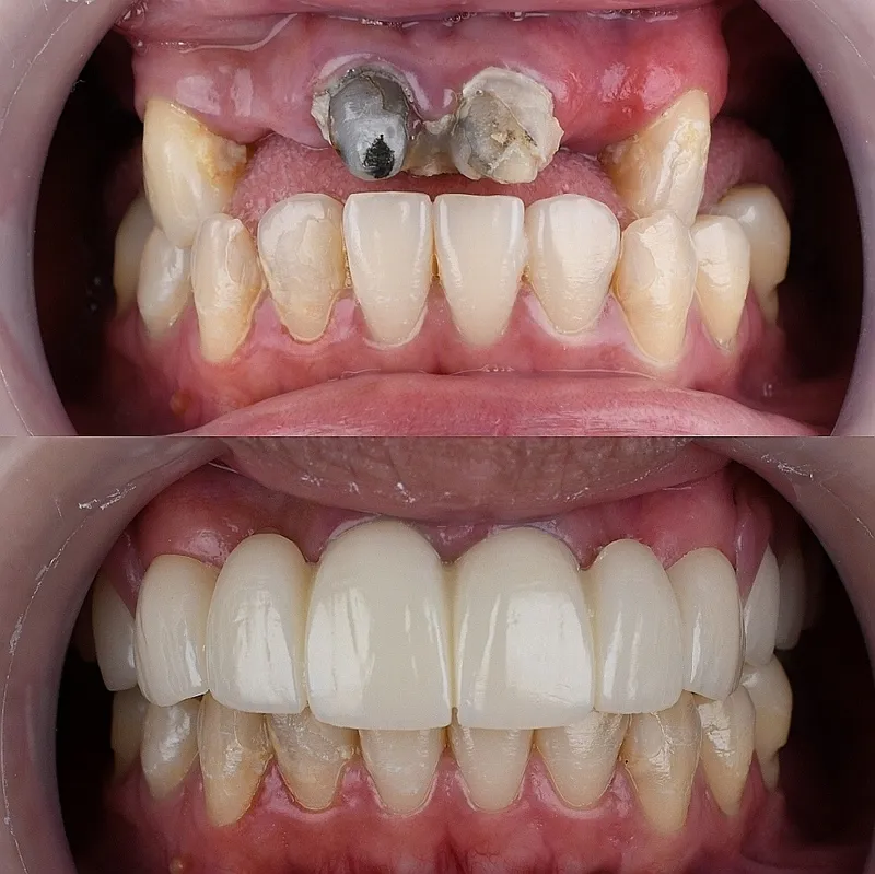 Full Arch Restoration