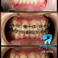 Orthodontic treatment case, before and after