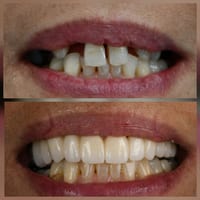 Crown restoration case, before and after