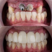 Full arch restoration case, before and after